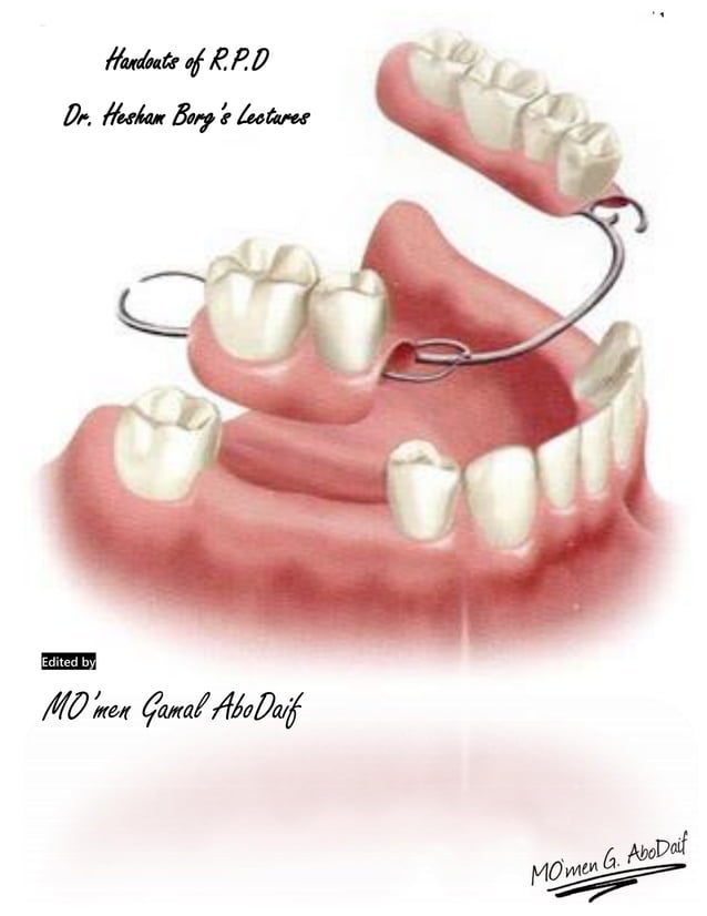 Removable partial denture _ Midterm PDF