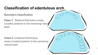 Classification of edentulous arch
Kennedy's classification
Class 1: Bilateral Edentulous areas,
Located posterior to the remaining natural
teeth
Class 2: Unilateral Edentulous
areas,Located posterior to the remaining
natural teeth
 