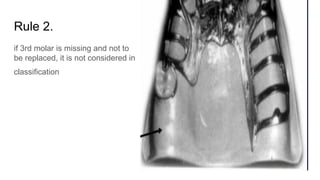 Rule 2.
if 3rd molar is missing and not to
be replaced, it is not considered in
classification
 