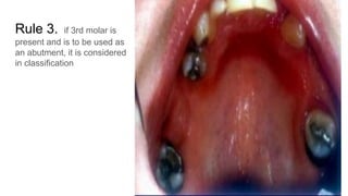 Rule 3. if 3rd molar is
present and is to be used as
an abutment, it is considered
in classification
 