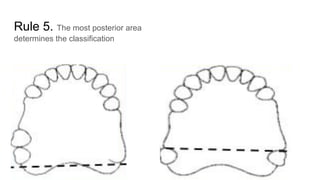 Rule 5. The most posterior area
determines the classification
 