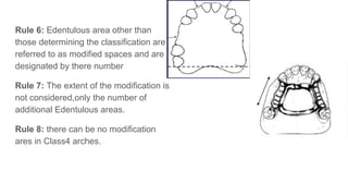 Rule 6: Edentulous area other than
those determining the classification are
referred to as modified spaces and are
designated by there number
Rule 7: The extent of the modification is
not considered,only the number of
additional Edentulous areas.
Rule 8: there can be no modification
ares in Class4 arches.
 