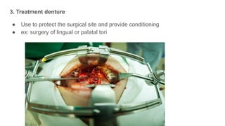 3. Treatment denture
● Use to protect the surgical site and provide conditioning
● ex: surgery of lingual or palatal tori
 