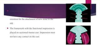Comprehensive Guide to Impressions for Removable Partial Dentures ...