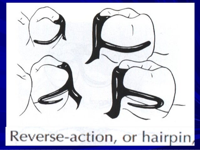 hairpin clasp Removable partial dentures(direct retiner) (1) hairpin clasp Removable partial dentures(direct retiner) (1)