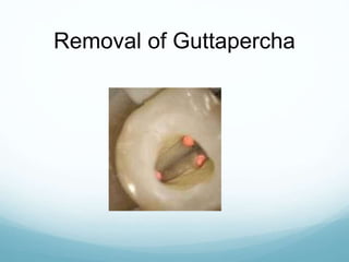 Removal of Guttapercha
 