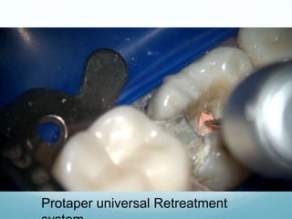 Protaper universal Retreatment
 