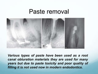 Paste removal
Various types of paste have been used as a root
canal obturation materials they are used for many
years but due to paste toxicity and poor quality of
filling it is not used now in modern endodontics.
 