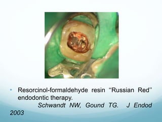 • Resorcinol-formaldehyde resin ‘‘Russian Red’’
endodontic therapy.
Schwandt NW, Gound TG. J Endod
2003
 