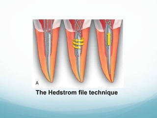 The Hedstrom file technique
 