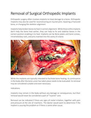 Removal of Surgical Orthopedic Implants
Orthopedic surgery often involves implants to treat damage to a bone. Orthopedic
Implants may also be used for reconstructing an injured joint, repairing a fractured
bone, or changing the skeleton alignment.
Implants help broken bones to heal in correct alignment. While these ortho implants
don’t help the bone heal earlier, they can help to fix and stabilize bones in the
correct position enabling it to heal. Implants can be Bone plates and bone screws,
intramedullary nails, and pins inserted into the cavity of a bone.
While the implants are typically intended to facilitate bone healing, its continuance
in the body after the bone union has taken place needs to be evaluated. Its removal
may be considered suitable and even necessary.
Indications
Implants may remain in the body without any damage or consequences, but their
removal would never be considered a part of "routine" care.
Removal can be indicated if there are signs of metal irritation, together with pain
and pressure at the site of insertions. The doctor would want to determine if the
implant is causing the problem or if there is some other cause.
 