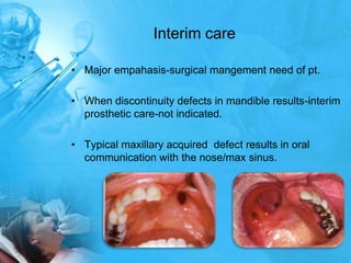 Interim careMajor empahasis-surgical mangementneed of pt.When discontinuity defects in mandible results-interim prosthetic care-not indicated.Typical maxillary acquired  defect results in oral communication with the nose/max sinus.