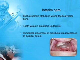 Interim careSuch prostheis-stabilized-wiring-teeth-alveolar bone.Teeth-wires in prostheis-undercutsImmediate placement of prostheis-pts acceptance of surgical defect.
