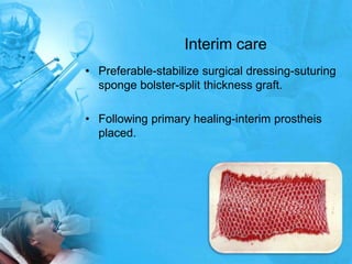 Interim carePreferable-stabilize surgical dressing-suturing sponge bolster-split thickness graft.Following primary healing-interim prostheis placed.