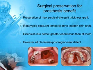 Surgical preservation for prosthesis benefitPreparation of max surgical site-split thickness graft.If pterygoidplate,ant temporal bone-support-skin graft.Extension into defect-greater-edentulous-than pt-teeth.However all pts-lateral-post region-seal defect.