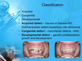 Classification Acquired CongenitalDevelopmentalAcquired defect – trauma or disease-RX    Soft/hardpalate defect-squamous cell carcinoma.Congenital defect – craniofacial defects - birth.Developmental defect – genetic predisposition-growth and development.