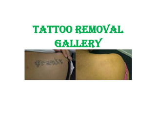 The BEST Tattoo Removal in Abbotsford QLD 4670 2023  Localsearch