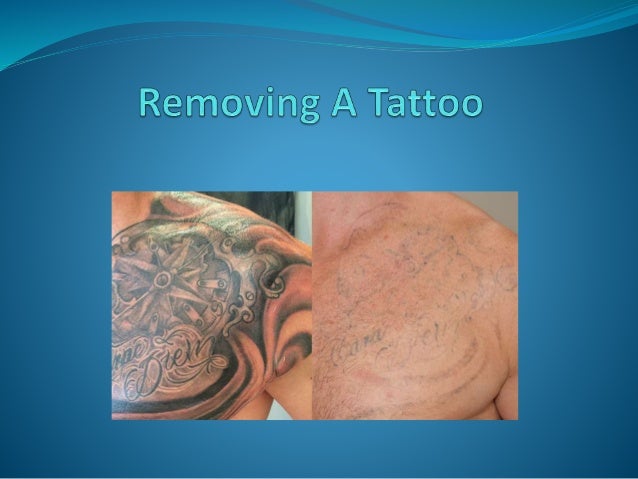 tips for removing a tattoo frank lao ifa tips for removing a tattoo frank lao ifa