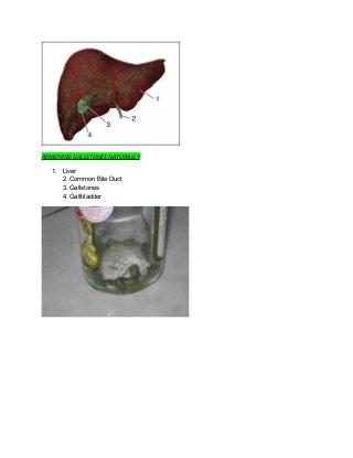 REMOVING GALLSTONES NATURALLY
1. Liver
2. Common Bile Duct
3. Gallstones
4. Gallbladder
 