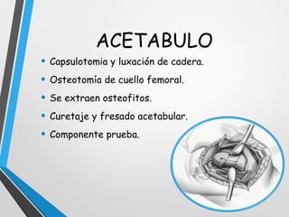 Remplazo total de cadera | PPT