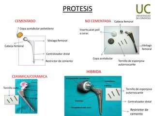 REMPLAZO TOTAL DE CADERA.pptx