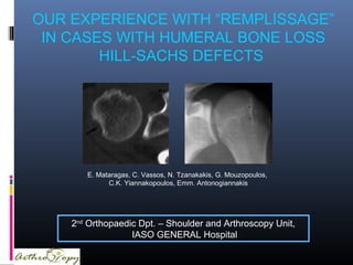 E. Mataragas, C. Vassos, N. Tzanakakis, G. Mouzopoulos,
C.K. Yiannakopoulos, Emm. Antonogiannakis
2nd
Orthopaedic Dpt. – Shoulder and Arthroscopy Unit,
IASO GENERAL Hospital
OUR EXPERIENCE WITH “REMPLISSAGE”
IN CASES WITH HUMERAL BONE LOSS
HILL-SACHS DEFECTS
 