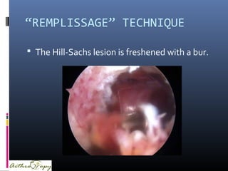 “REMPLISSAGE” TECHNIQUE
 The Hill-Sachs lesion is freshened with a bur.
 