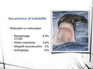 • Dislocation or subluxation
• Remplissage 6.3%
21/333
• Weber osteotomy 5.6%
• Allograft reconstruction 0%
• Arthroplasty 14%
Recurrence of instability
 