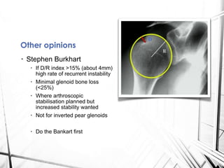 • Stephen Burkhart
• If D/R index >15% (about 4mm)
high rate of recurrent instability
• Minimal glenoid bone loss
(<25%)
• Where arthroscopic
stabilisation planned but
increased stability wanted
• Not for inverted pear glenoids
• Do the Bankart first
Other opinions
 