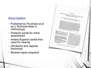 • Published by Purchase et.al
as a Technical Note in
Arthroscopy
• Posterior portal for initial
assessment
• Antero-Superior portal then
used for viewing
• Hill-Sachs and capsule
freshened
• Bankart repair prepared
Description
 