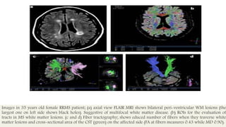 Images in 35 years old female RRMS patient; (a) axial view FLAIR MRI shows bilateral peri-ventricular WM lesions (the
largest one on left side shows black holes). Suggestive of multifocal white matter disease. (b) ROIs for the evaluation of
tracts in MS white matter lesions. (c and d) Fiber tractography; shows educed number of fibers when they traverse white
matter lesions and cross-sectional area of the CST (green) on the affected side (FA at fibers measures 0.43 while MD 0.90).
 