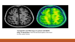 Amyloid-PET and MRI image of a patient with RRMS
using 18F-florbetaben. Note the decreased uptake of the tracer
in white matter lesions.
 