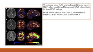 T2-weighted image (left), axial and sagittal Z-score map of
MWF values (middle) and histogram of MWF values (right)
for three PPMS patients.
PPMS Patient A had an EDSS of 1.5, Patient B had an
EDSS of 5.5 and Patient C had an EDSS of 6.5
 