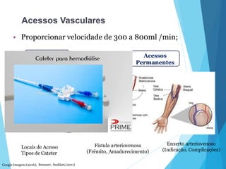 Acessos Vasculares
Fístula arteriovenosa
(Frêmito, Amadurecimento)
Enxerto arteriovenoso
(Indicação, Complicações)
HD Aguda
• Proporcionar velocidade de 300 a 800ml /min;
Acessos
Permanentes
Google Imagens (2016); Brunner , Suddart,(2011)
Locais de Acesso
Tipos de Cateter
 