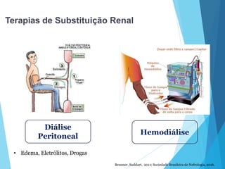 Terapias de Substituição Renal
Diálise
Peritoneal
Hemodiálise
Brunner, Suddart, 2011; Sociedade Brasileira de Nefrologia, 2016.
• Edema, Eletrólitos, Drogas
 