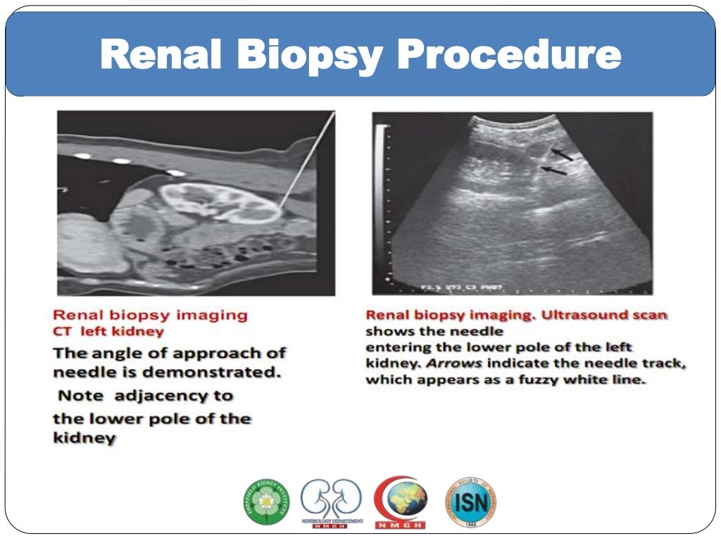 Renal biopsy