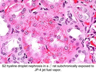 S2 hyaline droplet nephrosis in a ♂ rat subchronically exposed to
                      JP-4 jet fuel vapor.
 