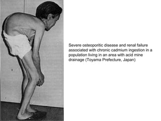 Severe osteoporitic disease and renal failure
associated with chronic cadmium ingestion in a
population living in an area with acid mine
drainage (Toyama Prefecture, Japan)
 