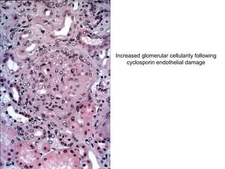 Increased glomerular cellularity following
     cyclosporin endothelial damage
 