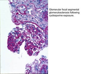 Glomerular focal segmental
glomerulosclerosis following
cyclosporine exposure.
 