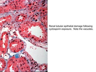 Renal tubular epithelial damage following
cyclosporin exposure. Note the vacuoles.
 