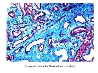 Cyclosporin interstitial fibrosis (trichrome stain)
 