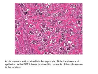 Acute mercuric salt proximal tubular nephrosis. Note the absence of
epithelium in the PCT tubules (eosinophilic remnants of the cells remain
in the tubules)
 
