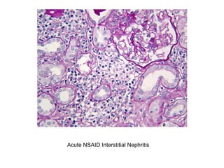 Acute NSAID Interstitial Nephritis
 
