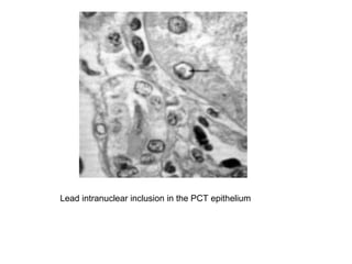 Lead intranuclear inclusion in the PCT epithelium
 