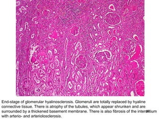 End-stage of glomerular hyalinosclerosis. Glomeruli are totally replaced by hyaline
connective tissue. There is atrophy of the tubules, which appear shrunken and are
surrounded by a thickened basement membrane. There is also fibrosis of the interstitium
                                                                                    54
with arterio- and arteriolosclerosis.
 