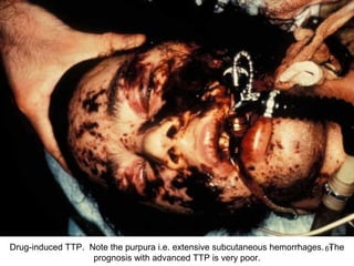 Drug-induced TTP. Note the purpura i.e. extensive subcutaneous hemorrhages. 61
                                                                             The
                   prognosis with advanced TTP is very poor.
 