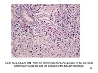 Acute drug-induced TIN. Note the prominent eosinophils present in the interstitial
        inflammatory response and the damage to the tubular epithelium.
                                                                               74
 