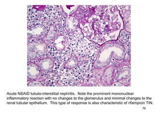 Acute NSAID tubulo-interstitial nephritis. Note the prominent mononuclear
inflammatory reaction with no changes to the glomerulus and minimal changes to the
renal tubular epithelium. This type of response is also characteristic of rifampicin TIN.
                                                                                  76
 