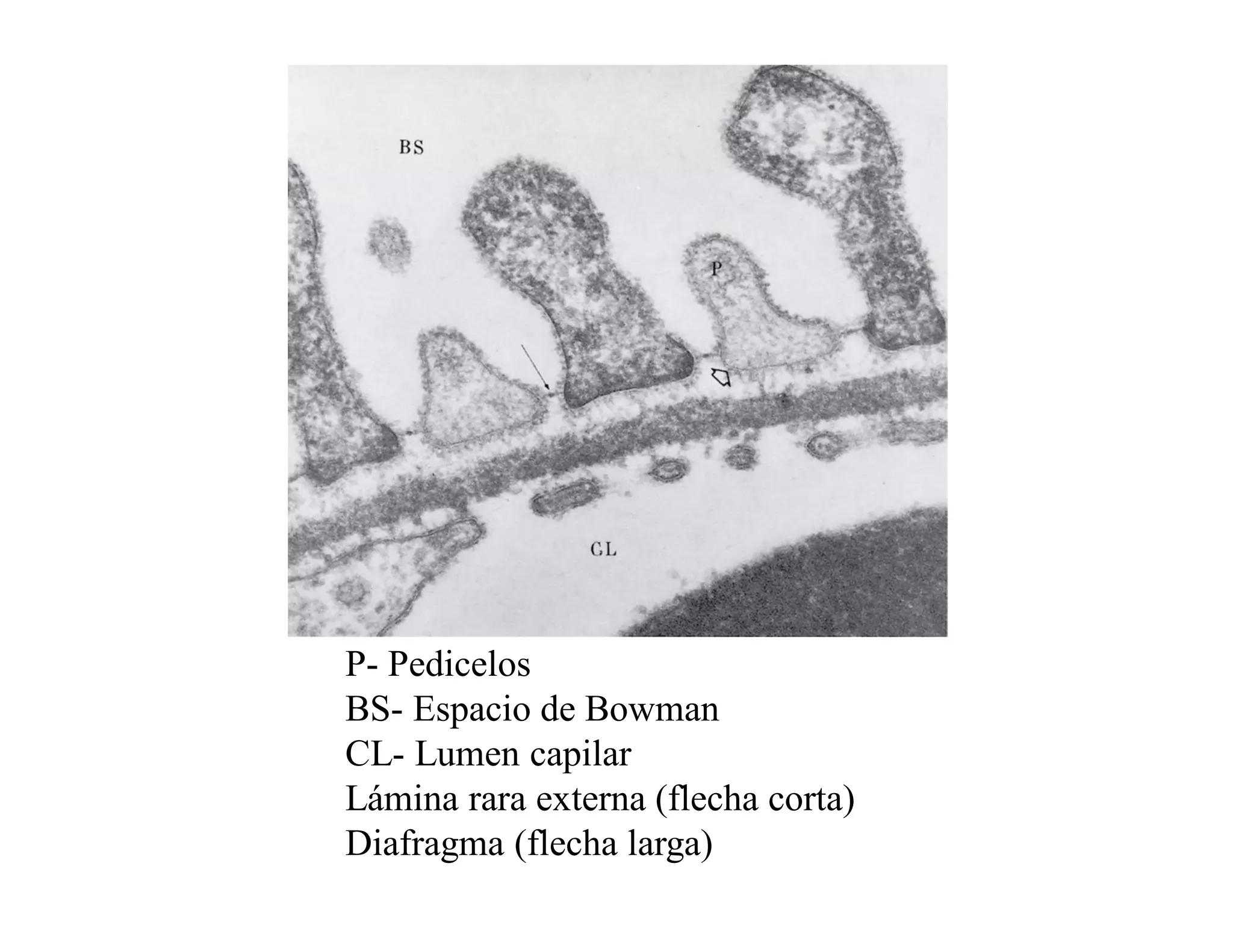 P- Pedicelos
BS- Espacio de Bowman
CL- Lumen capilar
Lámina rara externa (flecha corta)
Diafragma (flecha larga)

 